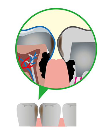 ①歯と歯の間から銀歯のサビが起こって虫歯になる