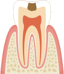 小さなむし歯になる