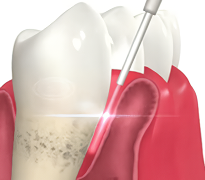 歯周ポケット内の殺菌